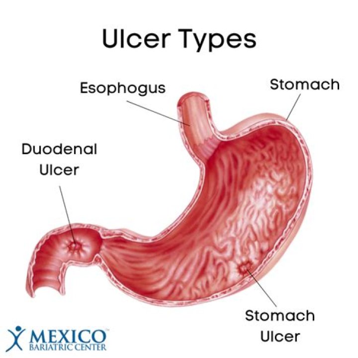 Marginal Ulcer Continues to Be a Major Source of Morbidity over Time Following Gastric Bypass